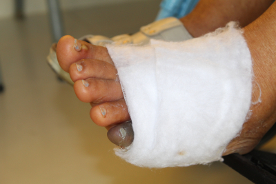 Hospital Marcelino Vélez disminuye niveles de amputación por pie diabético